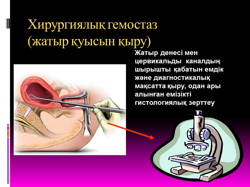 Хирургиялық гемостаз (жатыр қуысын қыру) Жатыр денесі мен цервикальды каналдың шырышты қабатын емдік және